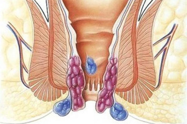 hemoroid